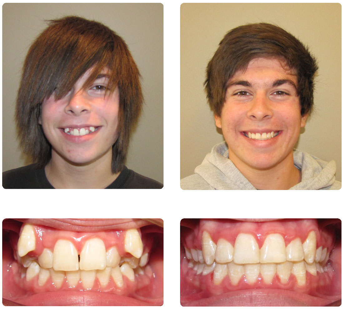 До скольки лет можно исправить. Зубы после брекетов до и после. Исправление зубов до и после.