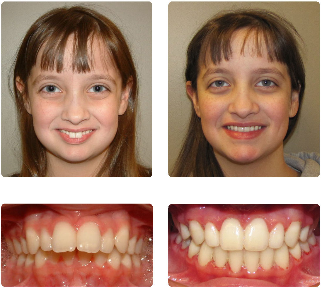 overbite before and after